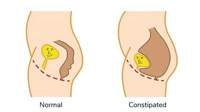 Illustration showing normal and constipated bowels