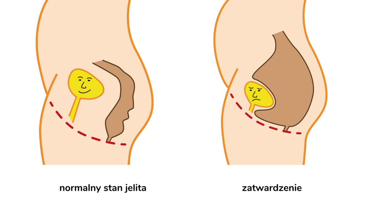 Constipated bowel and normal bowel graphic with polish labels