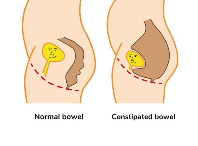 graphic showing a normal sized bowel that does not press on bladder next to a graphic of a large, constipated bowel that is pressing against the bladder