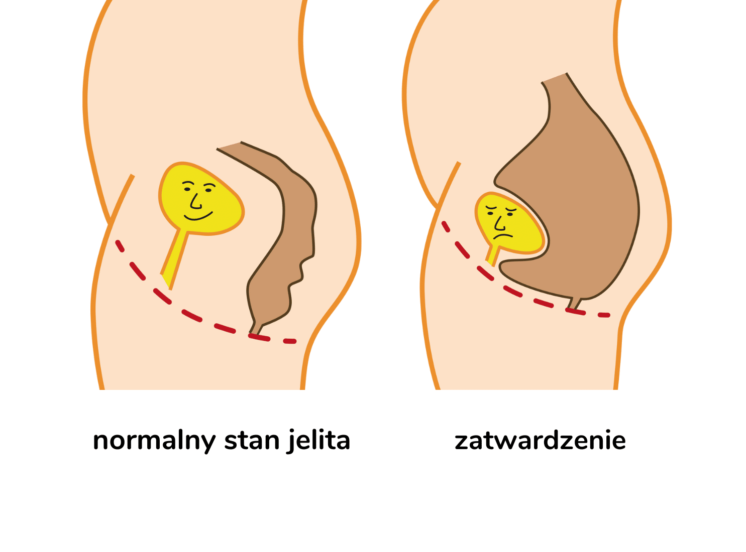 Image of a normal bowel v a constipated bowel