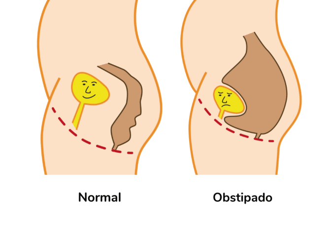 Normal v constipated bowel Portuguese