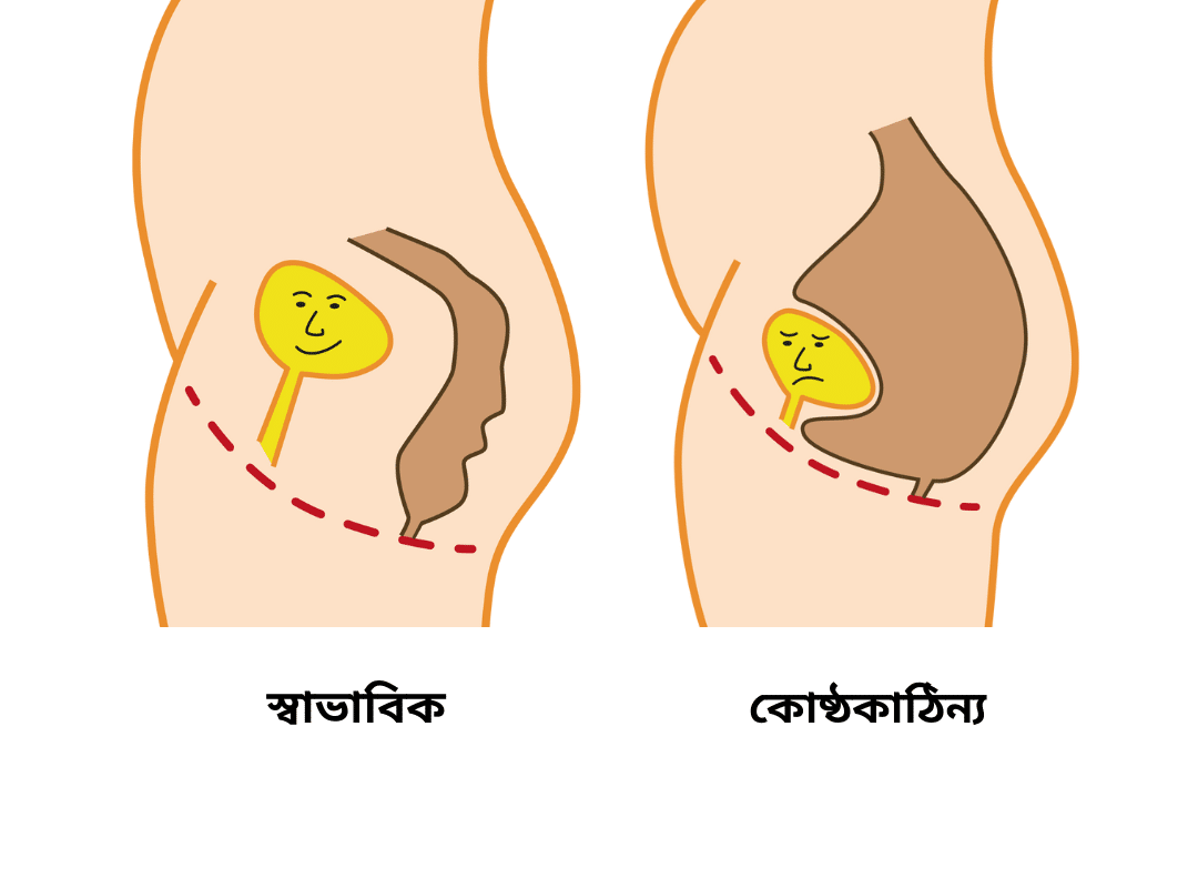 Image of bowels, one constipated and one normal - Bengali translation
