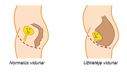 Image of constipated bowel with labels in Lithuanian